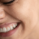 Ξηρό, Αφυδατωμένο Δέρμα