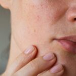 Ερυθρότητα